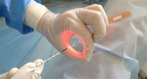 лечение на хемороиди с лазерна хирургия